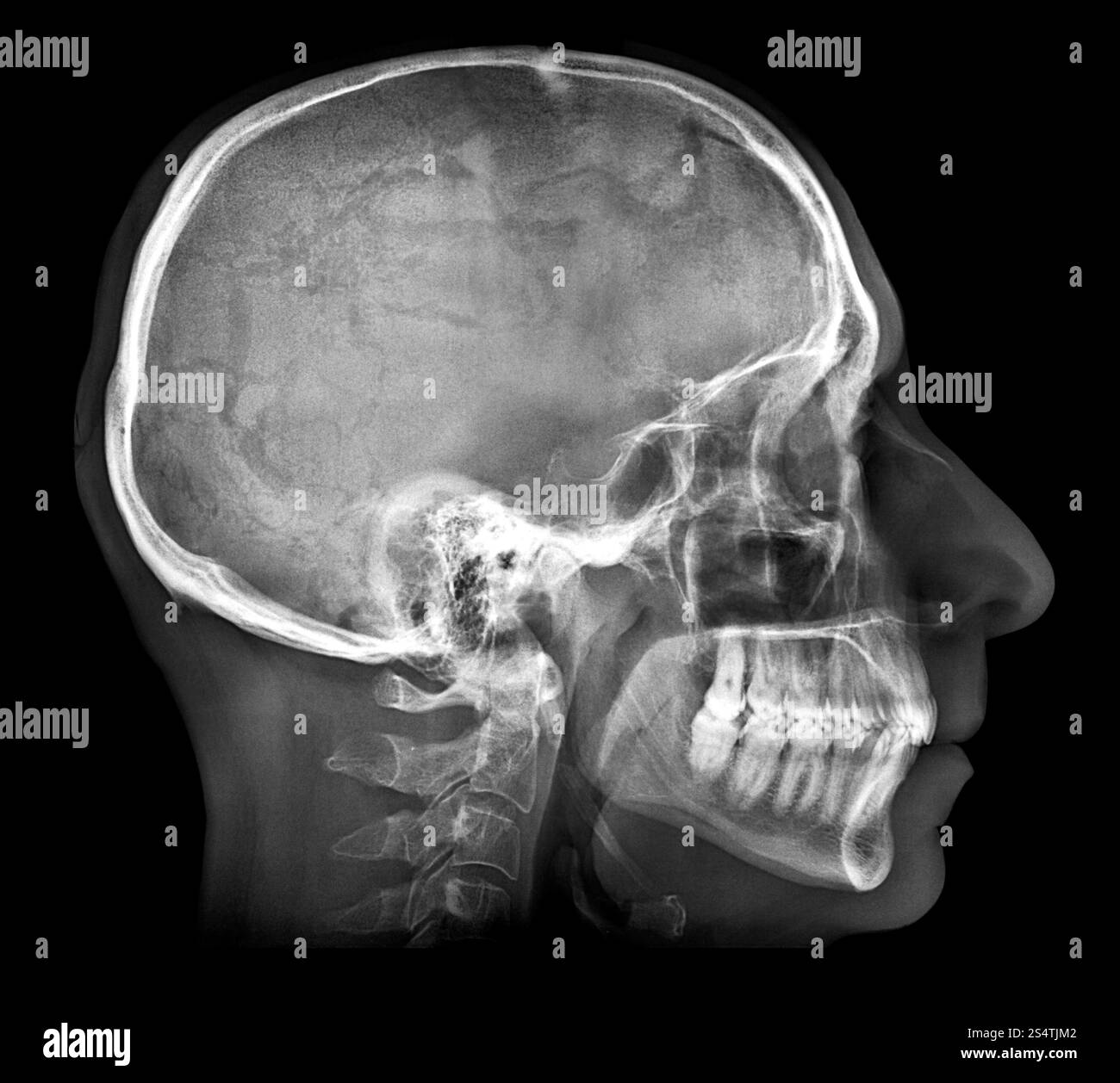 Röntgenbild des menschlichen Schädels isoliert auf Schwarz. Röntgenbild des menschlichen Schädels Stockfoto