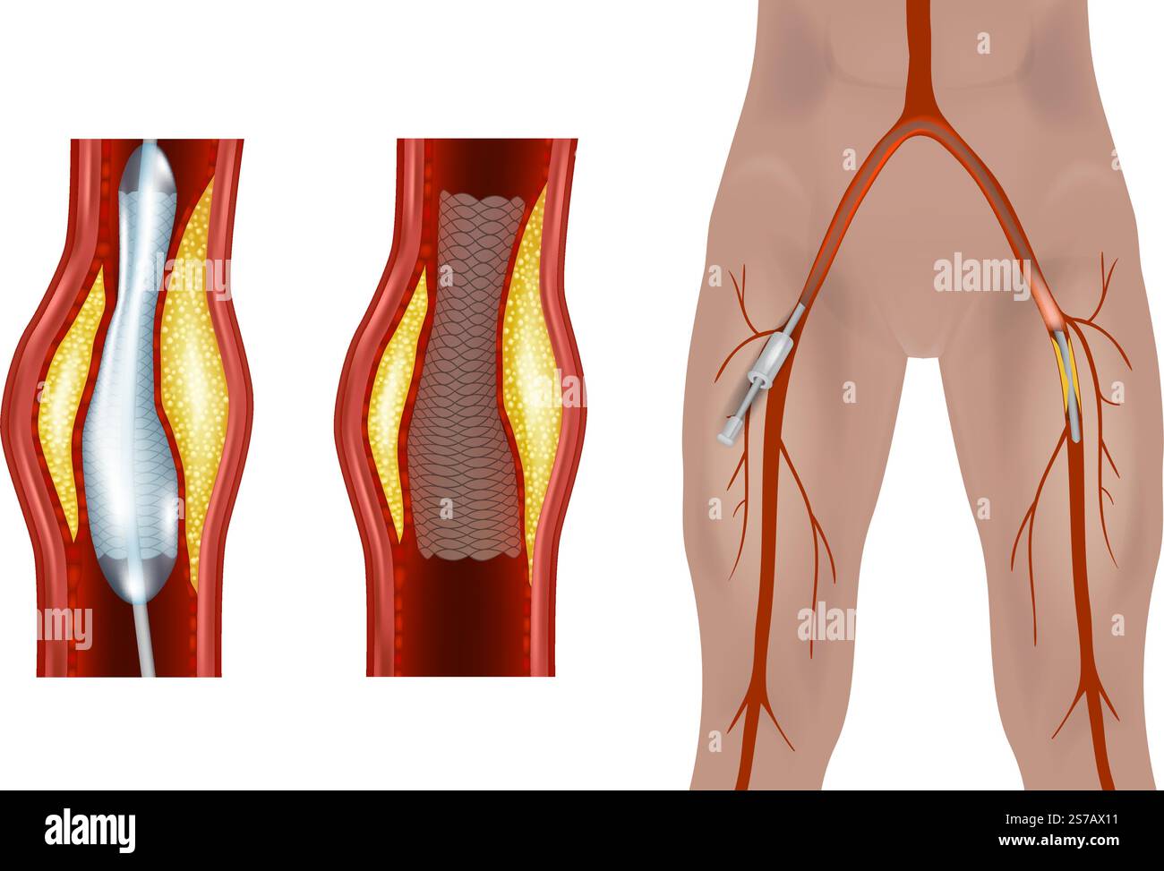 Femorales Endovaskuläres Verfahren. Abbildung der Femoralarterien und Poplitealarterien. Angioplastie der Arteria femoralis Stock Vektor