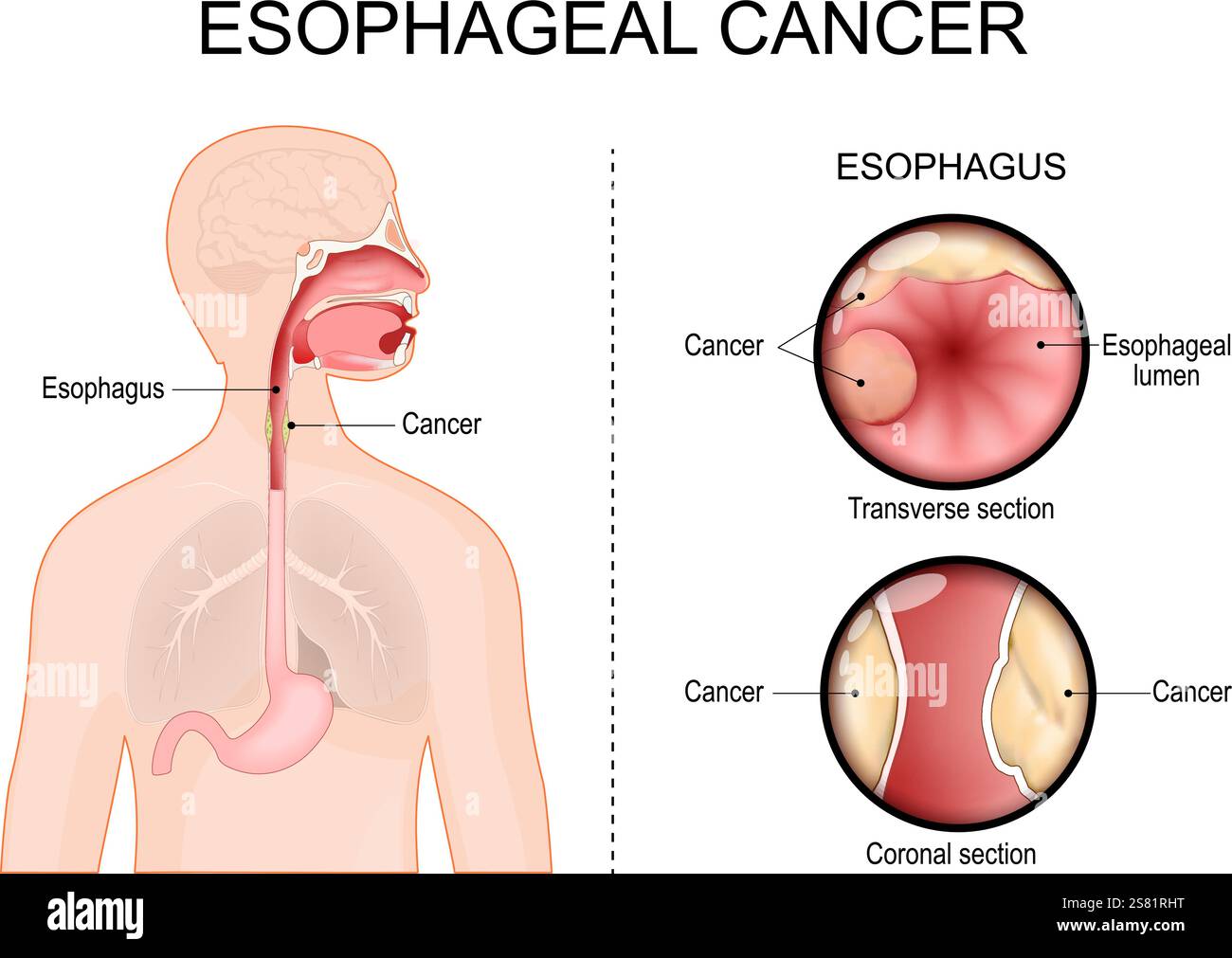 Osophaguskarzinom. Querschnitt und Koronalschnitt des Osophagus. Adenokarzinom. Nahaufnahme eines Osophaguslumens. Menschliche Silhouette mit Bauch, Stock Vektor