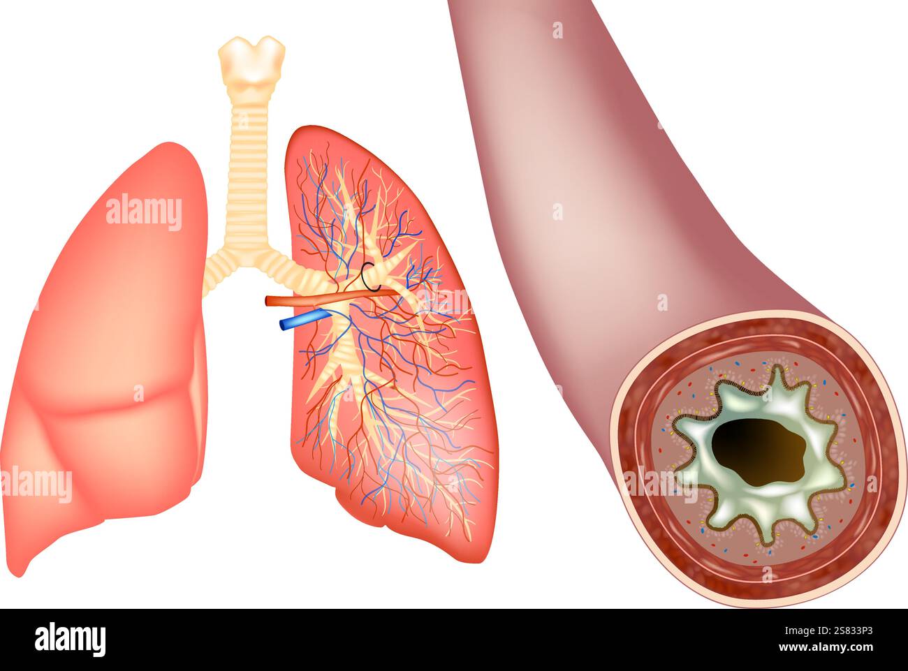 Bronchiektasen und erhöhter Sekretionsschleim. Menschlicher Bronchus im Schleimquerschnitt. Bakterielle Infektion in der Lunge Stock Vektor