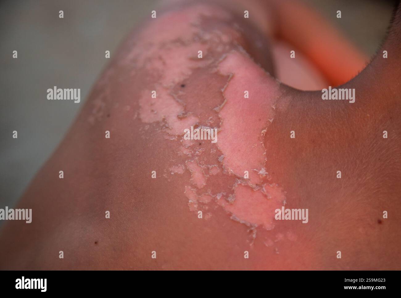 Eine Nahaufnahme der Haut, die einer Peeling-Behandlung unterzogen wird, zeigt die Entfernung von trockenen und toten Hautpartikeln und fördert ein gesünderes Aussehen in Al Stockfoto