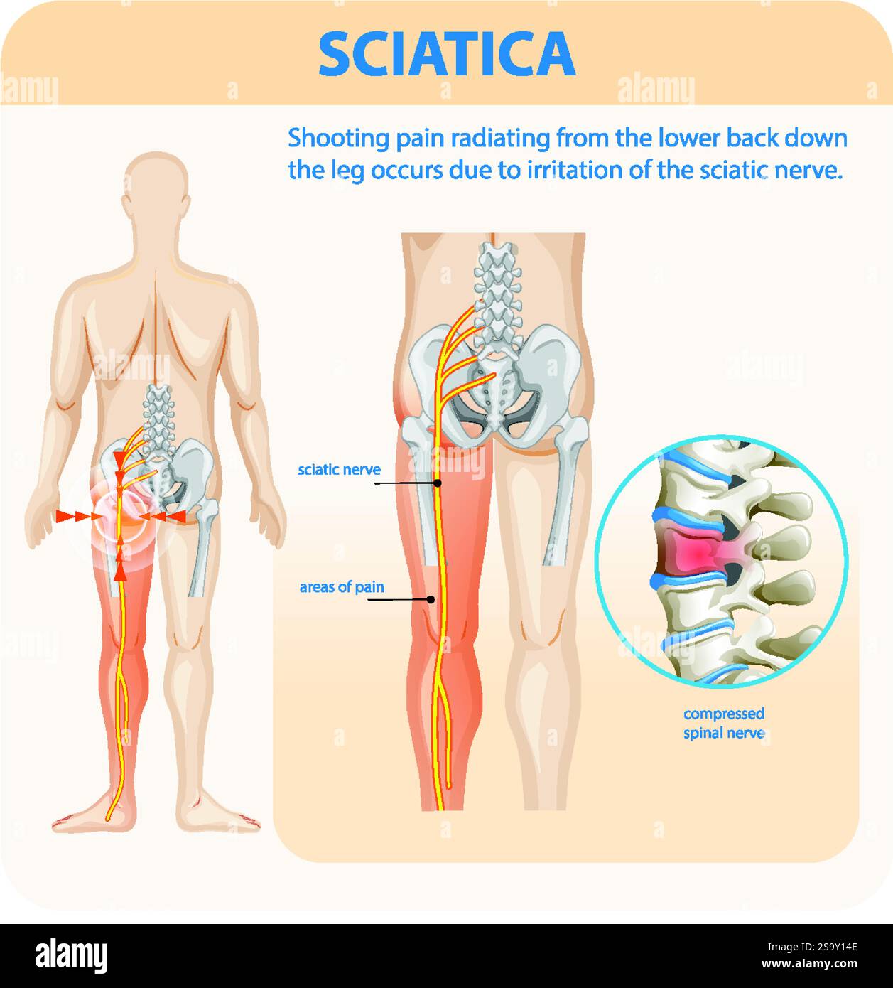 Illustration von Ischiasschmerz und Nervenkompression Stock Vektor