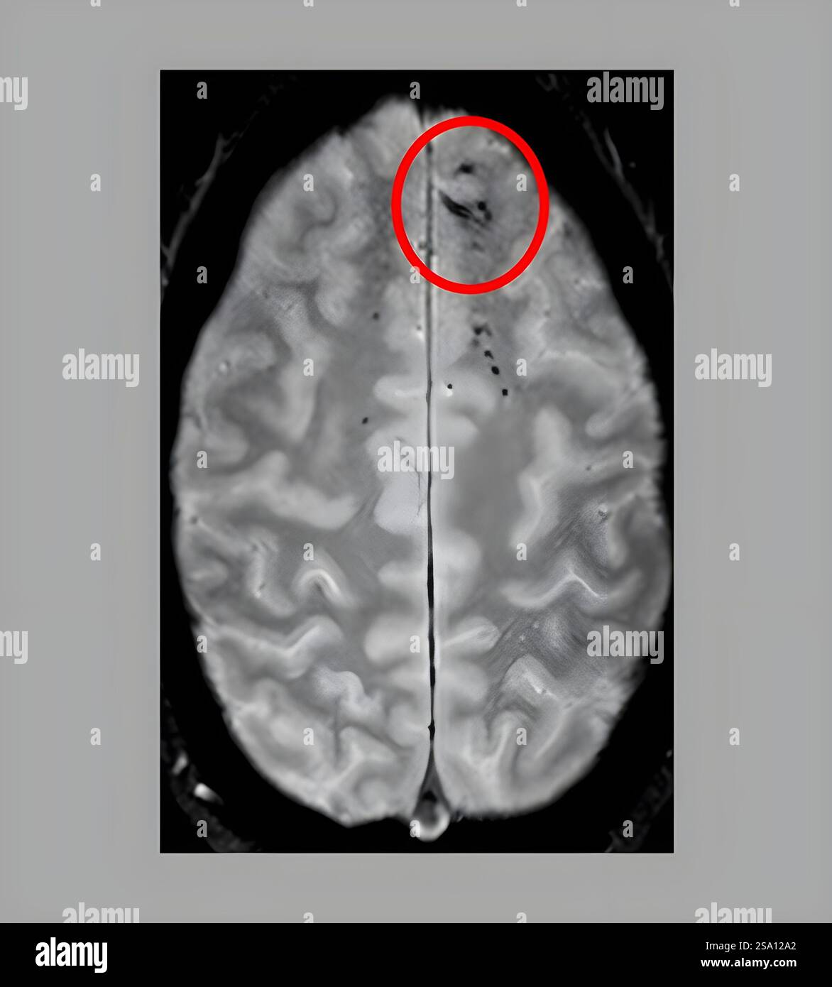 Traumatische Mikroblutungen treten bei MRT-Scans als dunkle Läsionen auf und deuten auf Schäden an den Blutgefäßen des Gehirns nach Kopfverletzung hin. Stockfoto