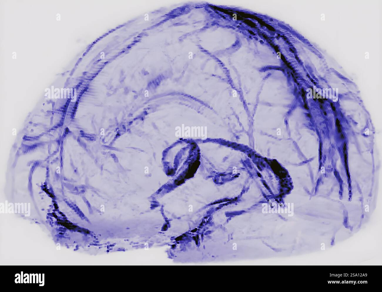 Gehirnscans von gesunden Freiwilligen haben gezeigt, dass menschliche Gehirne Abfälle durch Lymphgefäße, das Kanalsystem des Körpers, ableiten können. Stockfoto