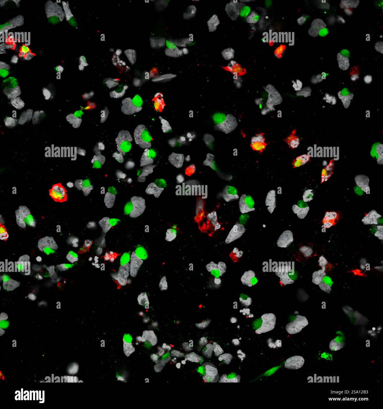 Menschliche neurale Vorläuferzellen (grau), die mit Zika-Virus (grün) infiziert sind, erhöhten das Enzym Caspase-3 (rot), was auf einen erhöhten Zelltod hindeutet. Stockfoto
