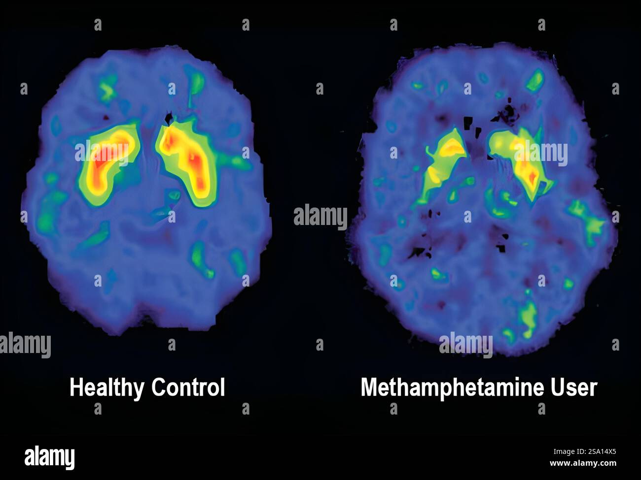 Methamphetamin-Missbrauch vermindert die Aktivität des Dopamin-Transporters und beeinträchtigt die mentale Funktion. Stockfoto