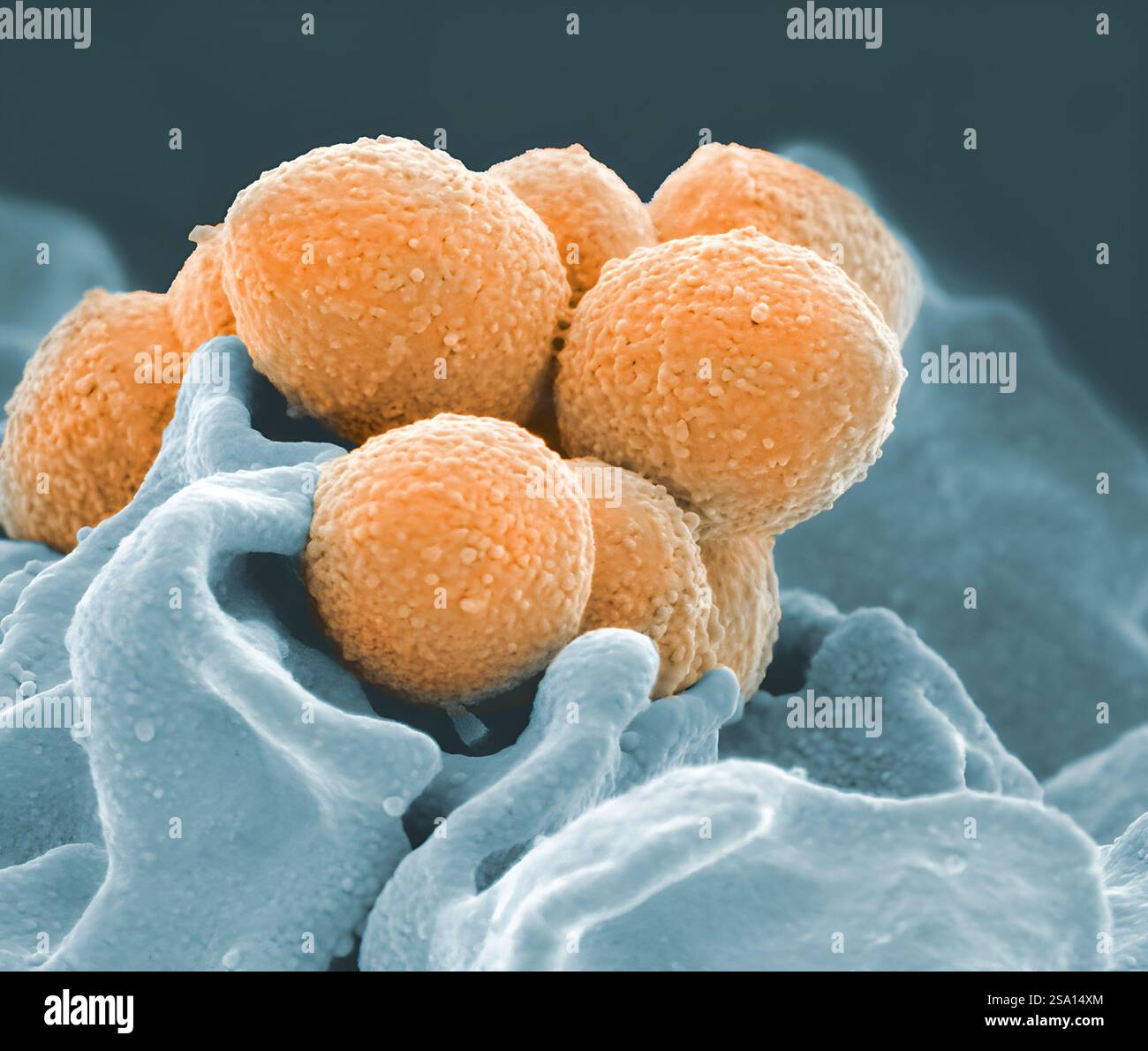 Bakterielle Streptokokken-Infektionen der Gruppe A können von einer leichten Hautinfektion über Halsschmerzen bis hin zu schweren, lebensbedrohlichen Zuständen reichen. Stockfoto