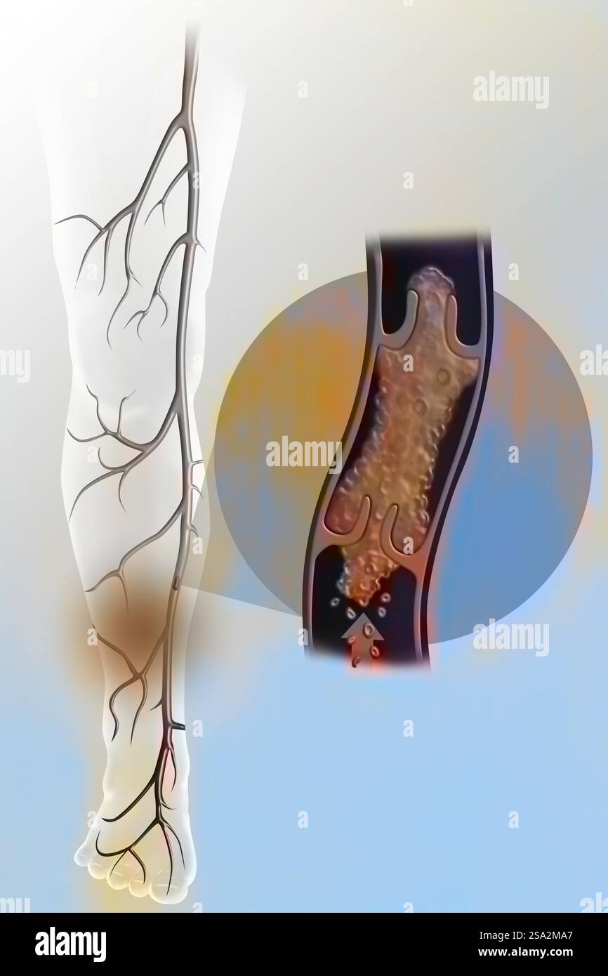 Oberflächliche Venenthrombose der unteren Extremität. Stockfoto