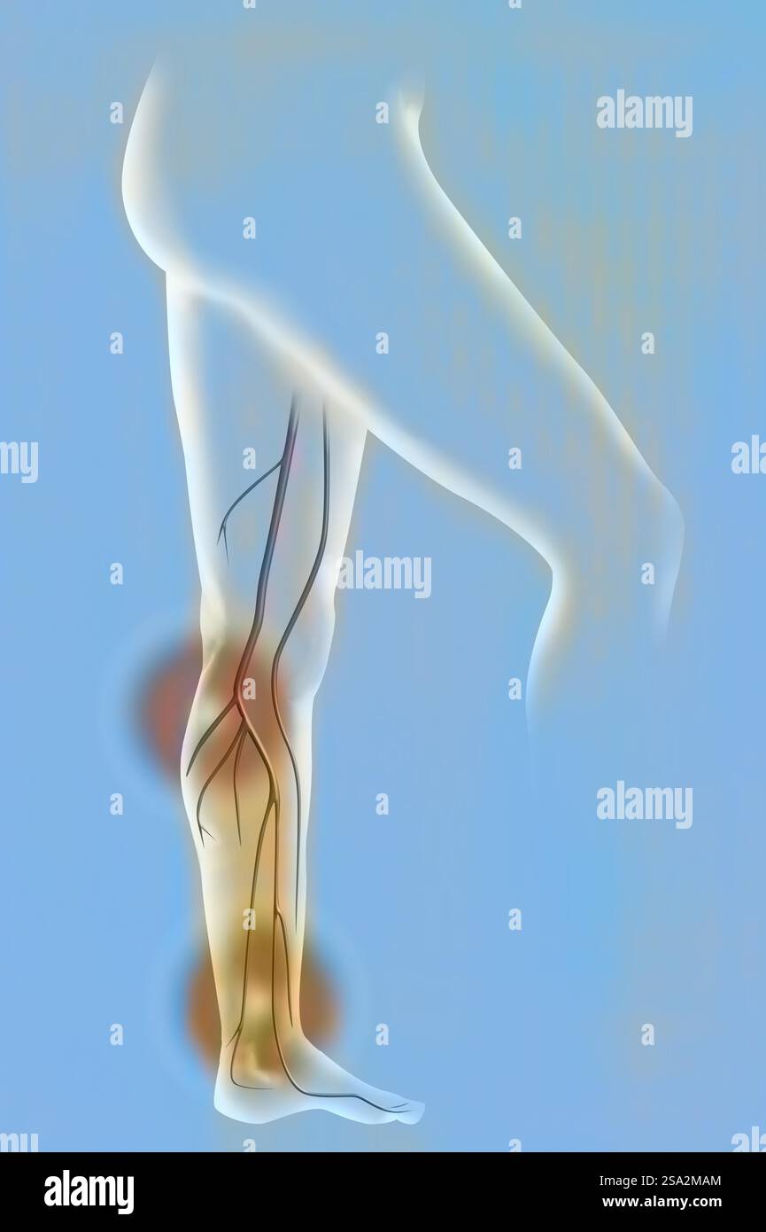 Darstellung von Beinschmerzen und insbesondere venöser Insuffizienz (hier auf Höhe der Vena poplitea und der Vena saphena externa). Stockfoto