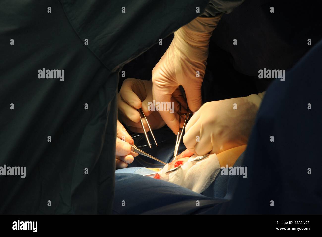 Operationssaal in der Kinderchirurgie an einem Kind. Stockfoto