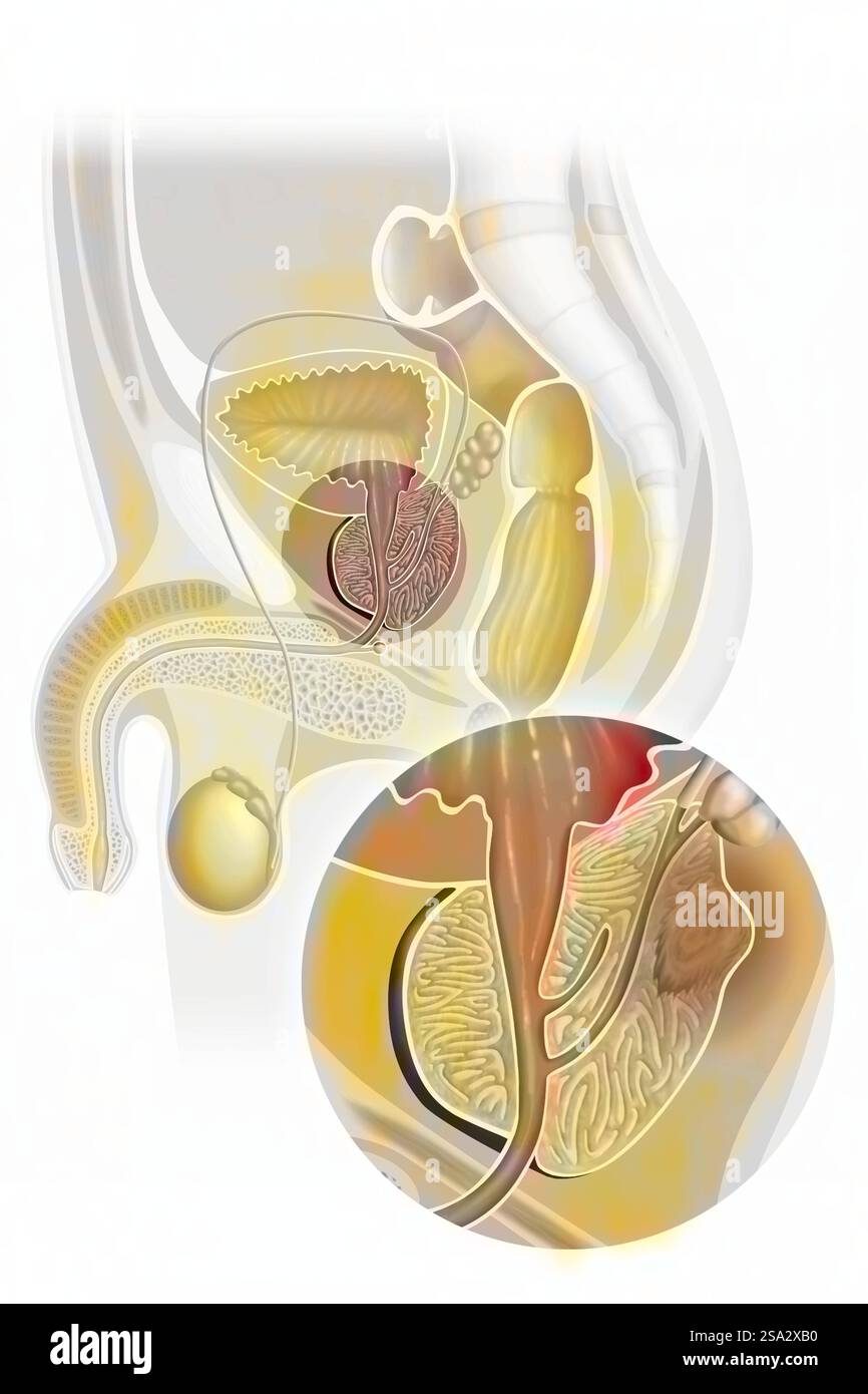 Prostatakarzinom meist Adenokarzinom. Prostatakarzinom Zeichnung 016238 020 Stockfoto