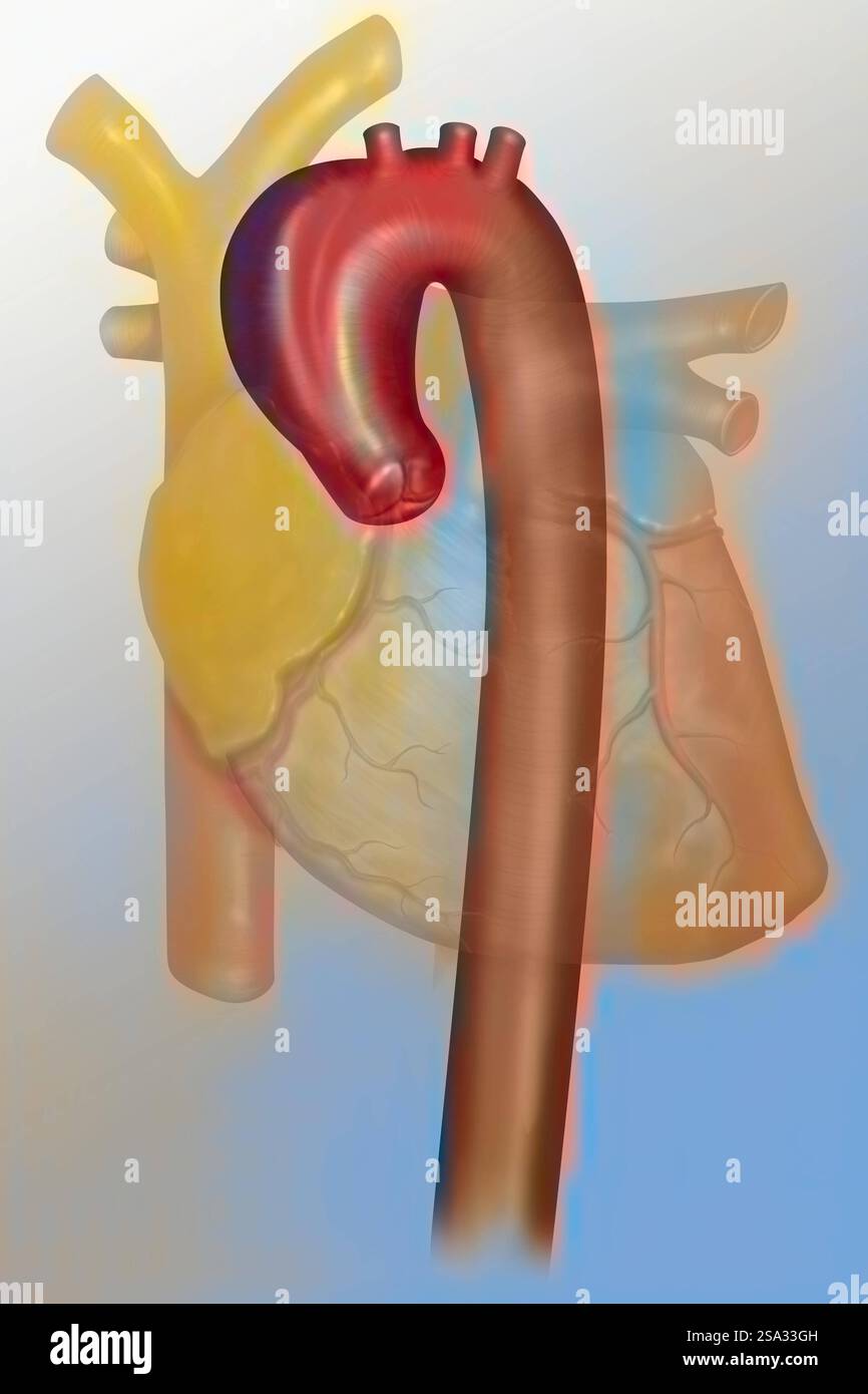Aneurysma des Aortenbogens der Aorta ascendens thoracalis. Ein Aneurysma ist eine lokalisierte Erweiterung der Wand einer Blutgefäßtasche, der Ruptur o Stockfoto