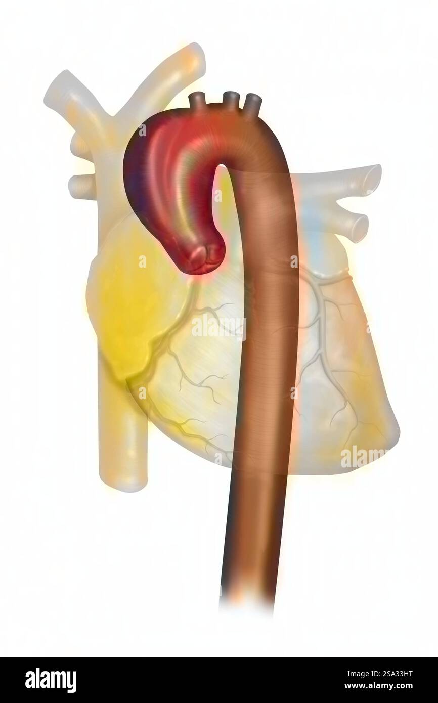 Aneurysma des Aortenbogens der Aorta ascendens thoracalis. Ein Aneurysma ist eine lokalisierte Erweiterung der Wand einer Blutgefäßtasche, der Ruptur o Stockfoto