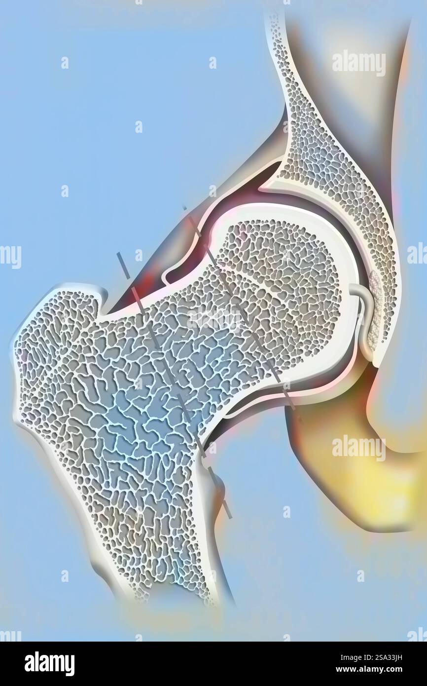 Osteoporose des Schenkelhalses und Lage der Frakturstellen. Siehe Bilder 1531507 für das koxofemorale Gelenk ohne Pathologie, 1531607 für Osteoarth Stockfoto