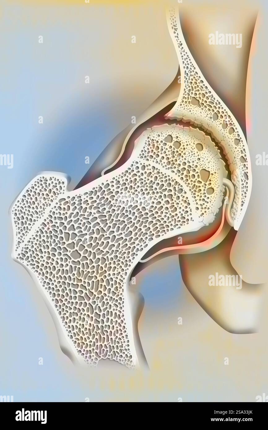 Hüftarthrose Femurkopf und Acetabulum. Der Knorpel am Oberschenkelkopf und das Acetabulum ist abgetragen, Osteophyten haben sich Knochenwuchse gebildet. Knochen t Stockfoto