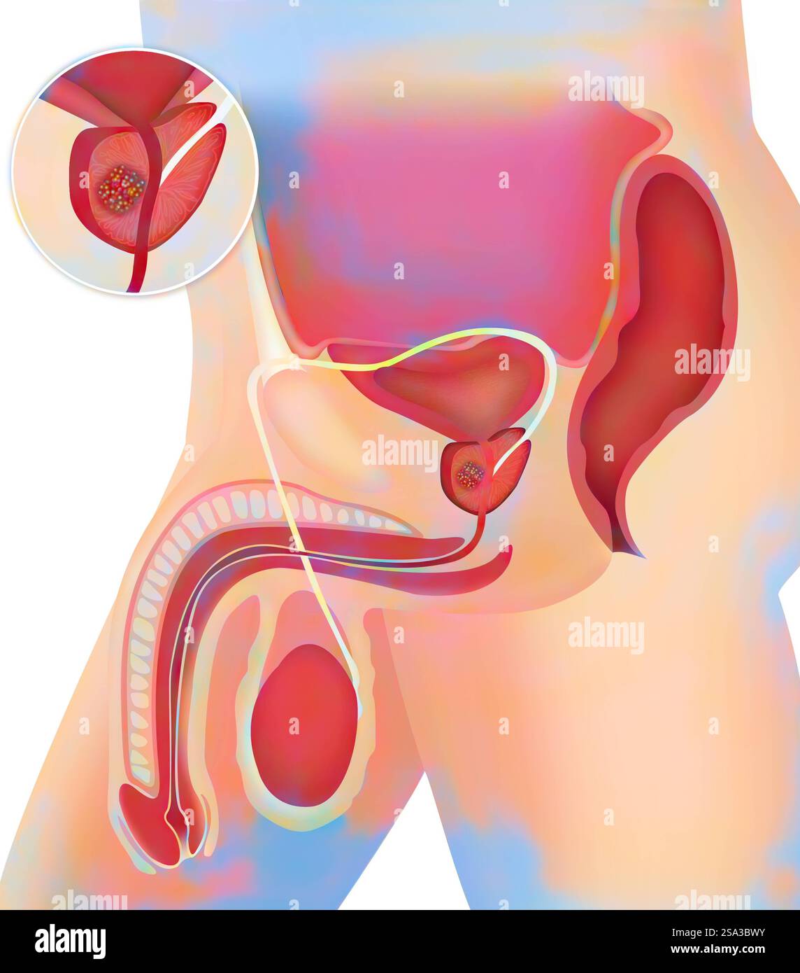 Prostatakarzinom, Zeichnung des Prostatakarzinoms, Zeichnung 016889 232 Stockfoto
