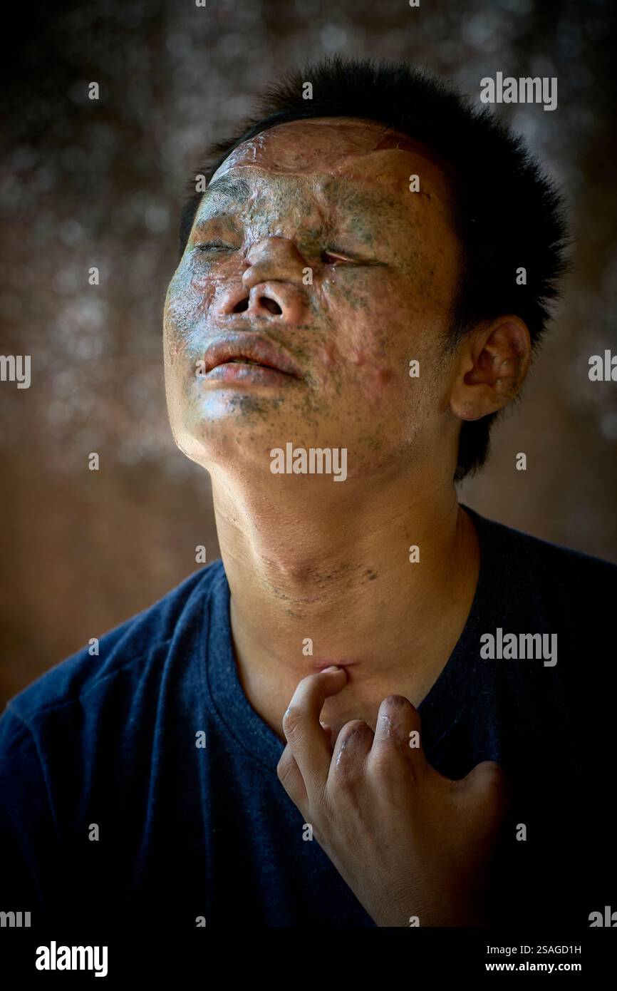 Tal El Soe, ein 20-jähriges Mitglied der oppositionellen Volksverteidigungstruppe, das angeblich als Minenräumer in Myanmar ausgebildet wurde. Stockfoto