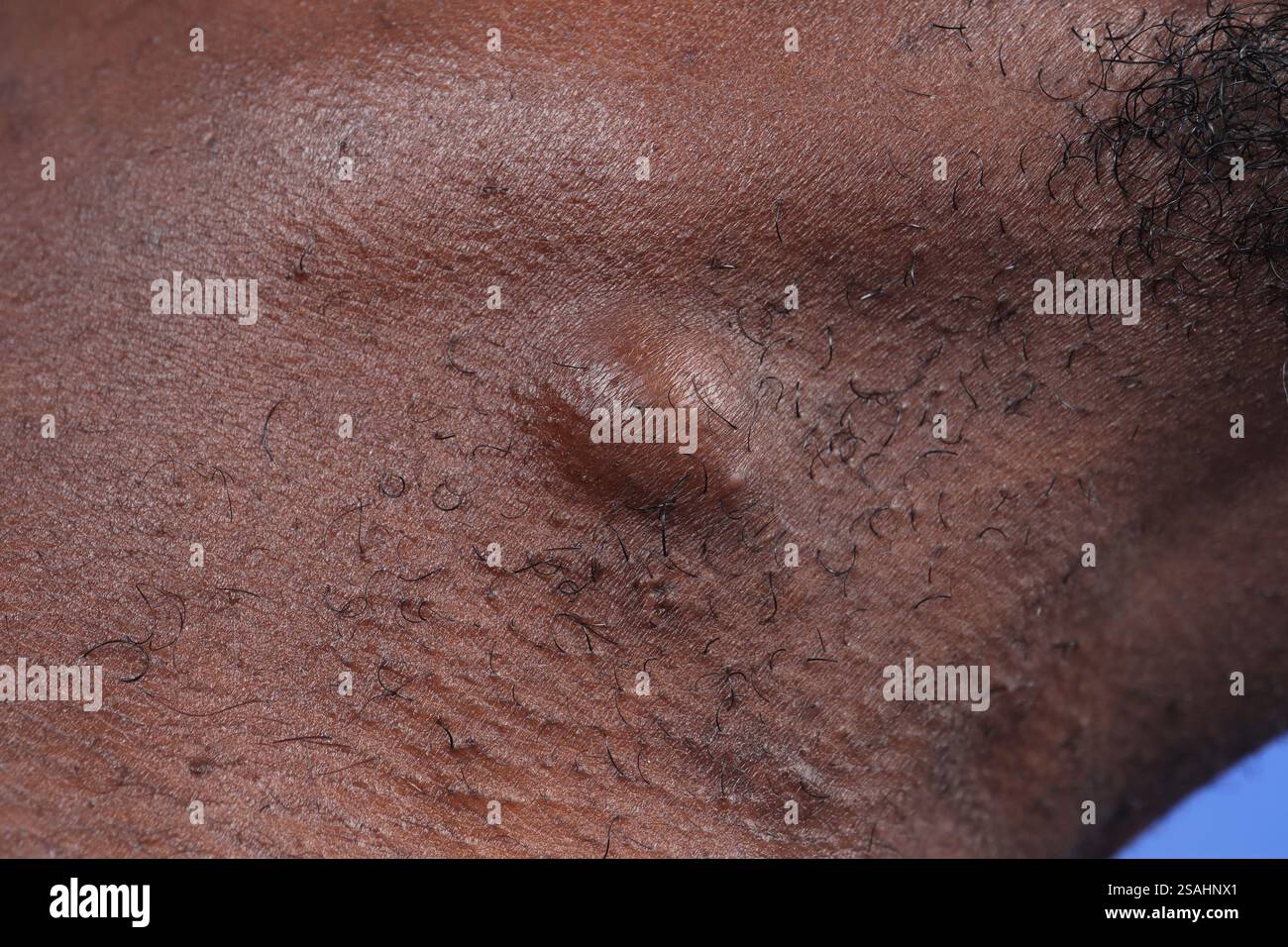 Die zervikale Talgzyste bei einem 29-jährigen Mann. Stockfoto