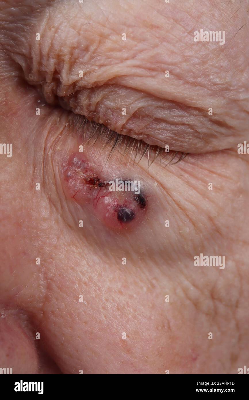 Noduläres Basalzellkarzinom des Unterlids bei einem 81-jährigen Mann. Stockfoto