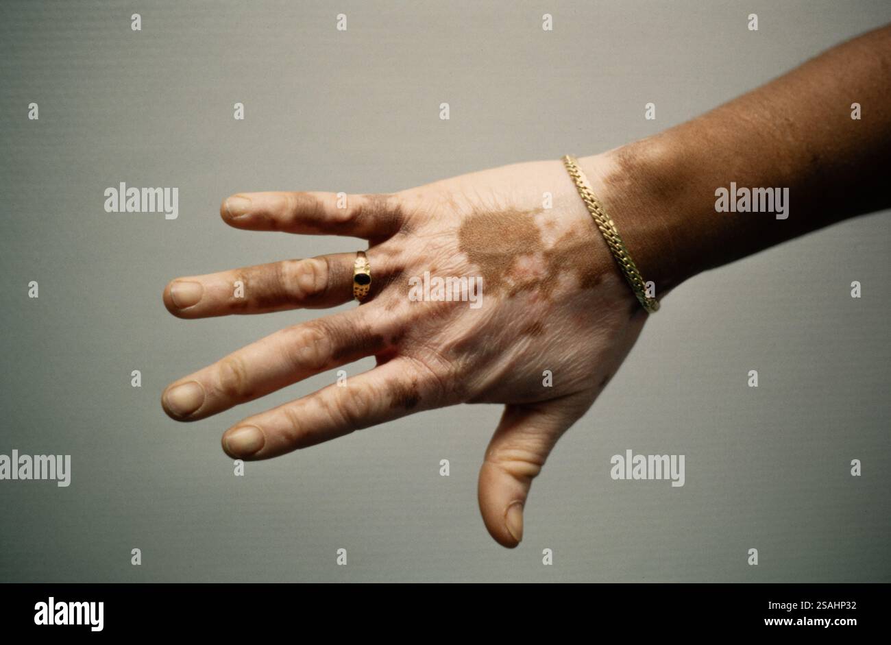 Vitiligo oder Achromie ist eine Autoimmunerkrankung, die mit einer Funktionsstörung des Immunsystems verbunden ist. Stockfoto