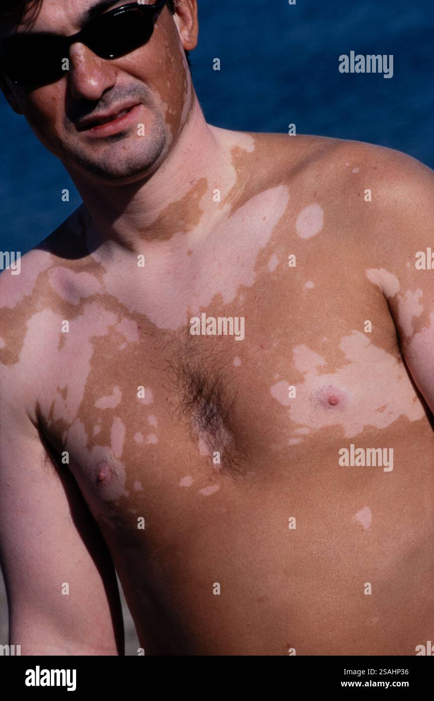 Vitiligo oder Achromie ist eine Autoimmunerkrankung, die mit einer Funktionsstörung des Immunsystems verbunden ist. Stockfoto