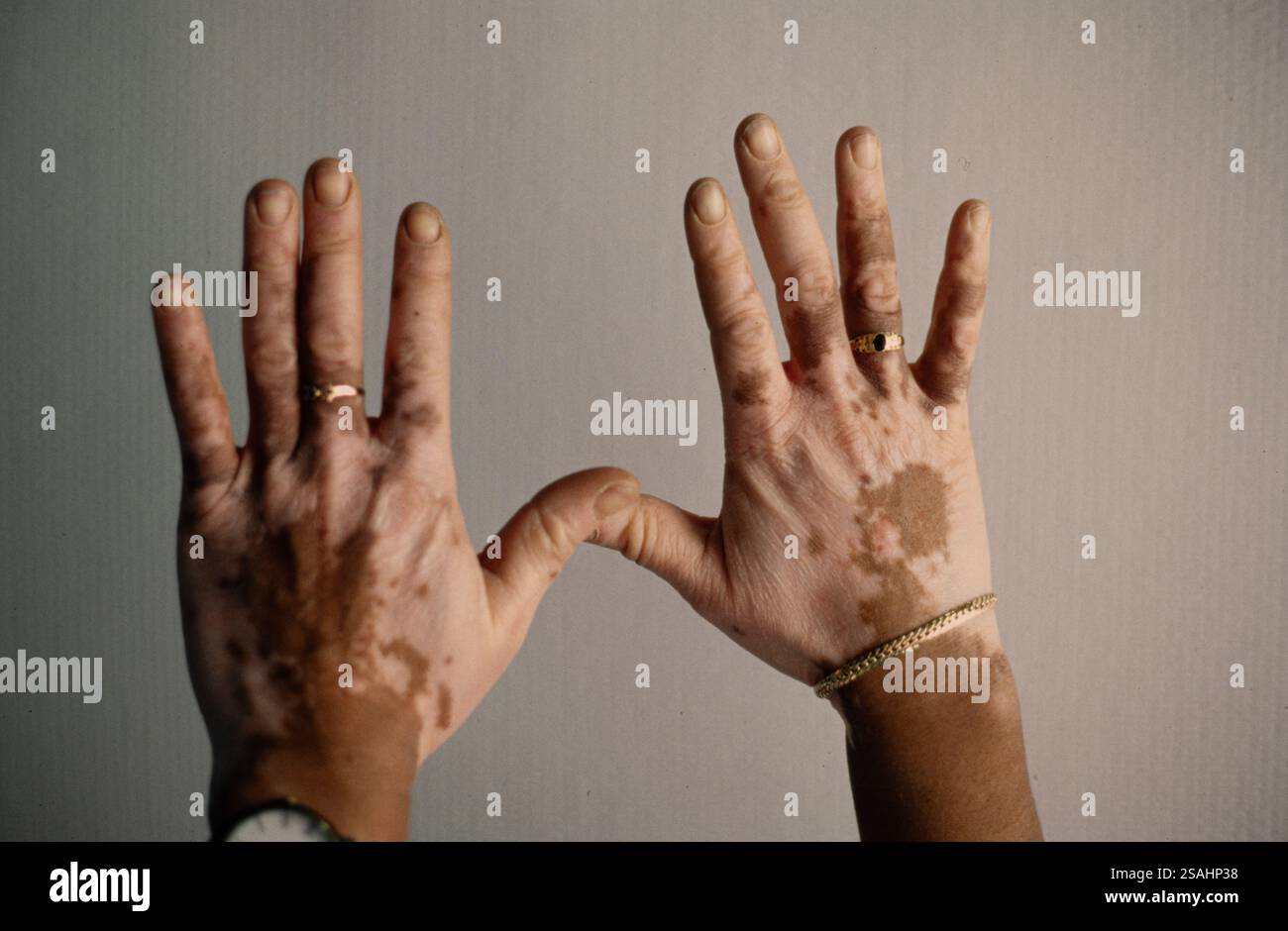 Vitiligo oder Achromie ist eine Autoimmunerkrankung, die mit einer Funktionsstörung des Immunsystems verbunden ist. Stockfoto