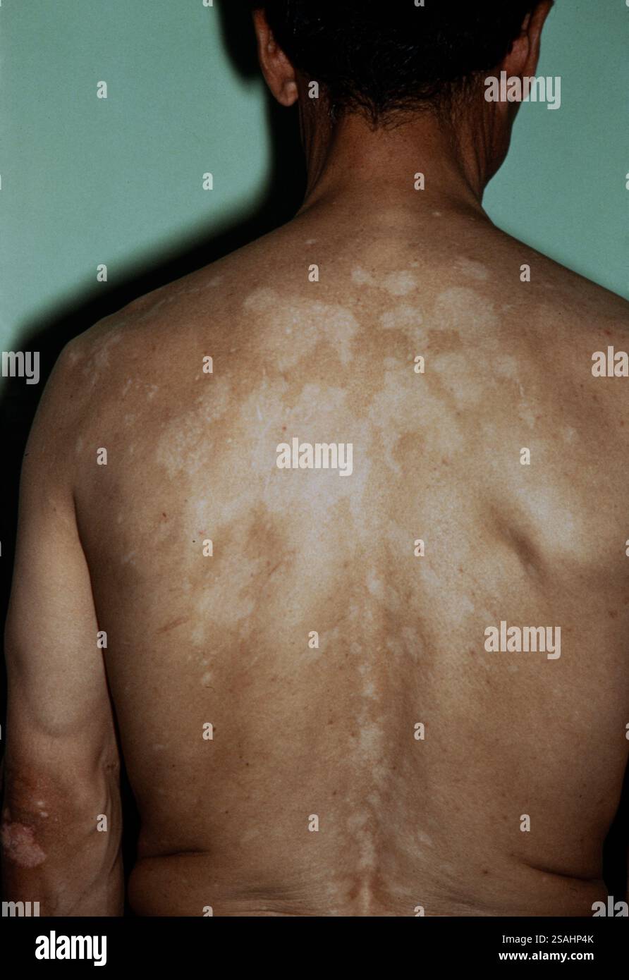 Vitiligo oder Achromie ist eine Autoimmunerkrankung, die mit einer Funktionsstörung des Immunsystems verbunden ist. Stockfoto