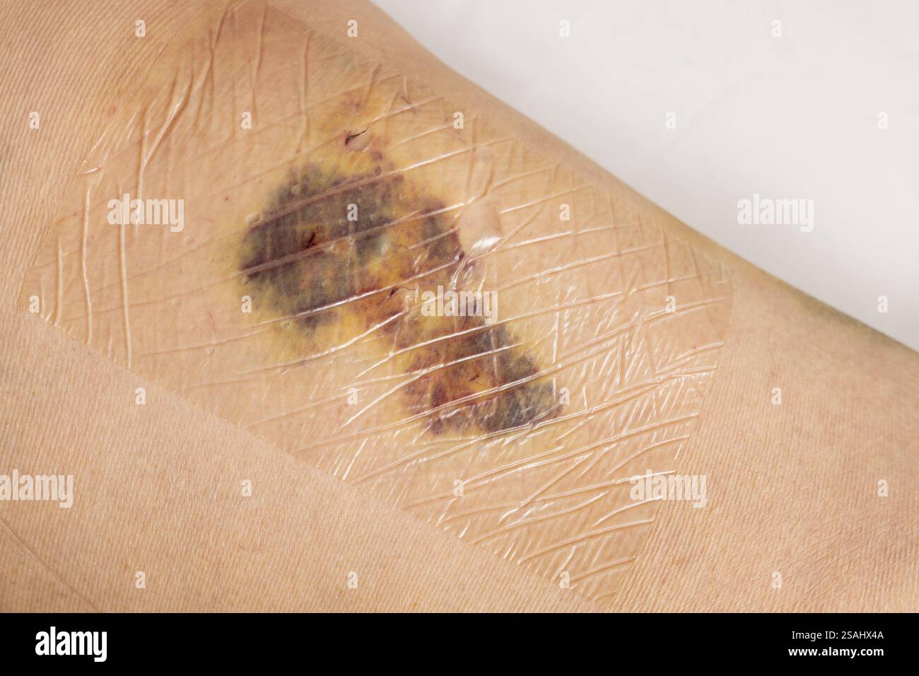 Frauenbeine nach Krampfaderchirurgie mit sichtbaren chirurgischen Nahtnähten und Wunden am Bein. Kurative Behandlung, ästhetische Eingriffe, Thrombosen Stockfoto