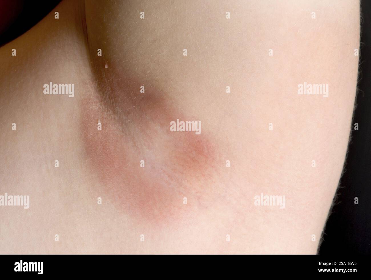 Eine Achselhöhle mit einer Hefe-Infektion Stockfoto