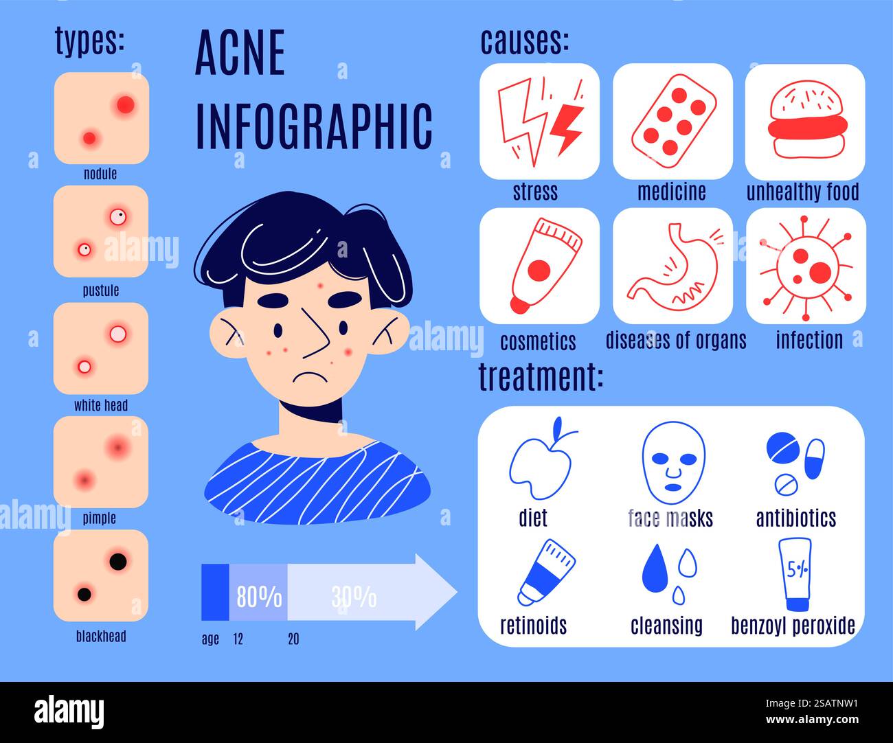 Infografik zum Problem des Mannes. Aufklärendes Poster „Akne stoppen“. Ursachen, Vorbeugung und Behandlung, trauriger Kerl mit Gesichtspickel, Kritzelstil Charakterzeichnung, schickes Comic Flat Style isoliertes Konzept. Infografik zum Problem des Mannes. Aufklärendes Poster „Akne stoppen“. Ursachen, Vorbeugung und Behandlung, trauriger Kerl mit Pickel im Gesicht, Kritzelcharakter. Schickes, flaches, isoliertes Konzept in Cartoon-Stil Stock Vektor