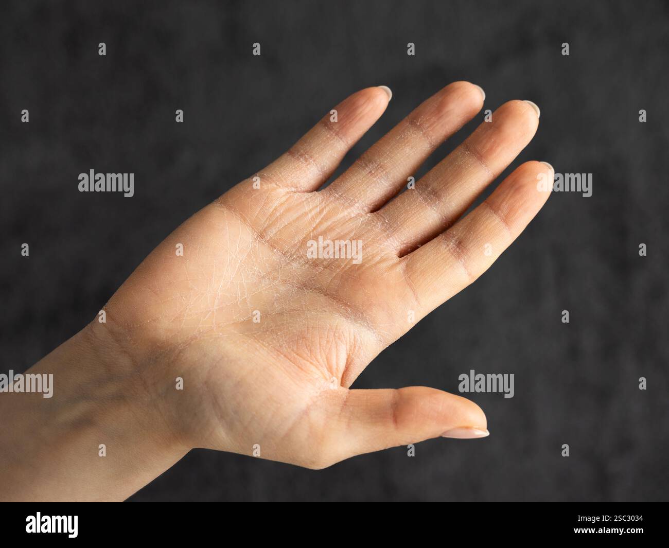 Hand-Ekzem Nahaufnahme. Auch bekannt als Dermatitis. Trockene Haut aufgrund von Umweltbedingungen. Hautablösung und Verkrustungen, die Juckreiz und Schmerzen verursachen. Stockfoto