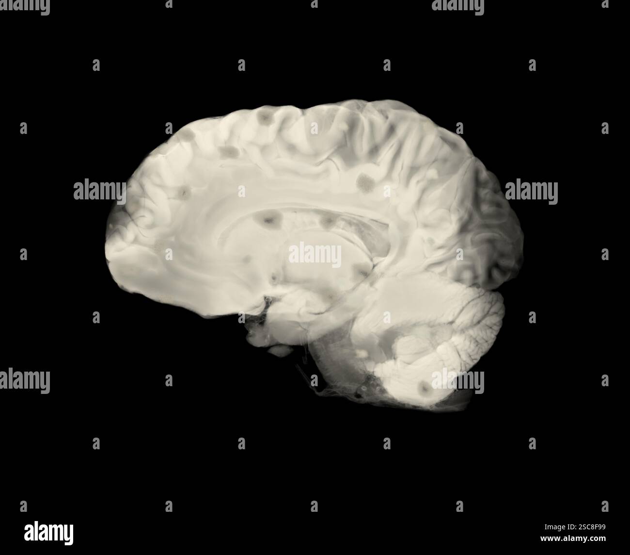 Medizinisches Bild des sagittalen Abschnitts eines Gehirns, das dunkle Flecken zeigt, die auf Multiple Sklerose-Läsionen hindeuten und die Blut-Hirn-Schranke-Dysfunktionen hervorhebt Stockfoto