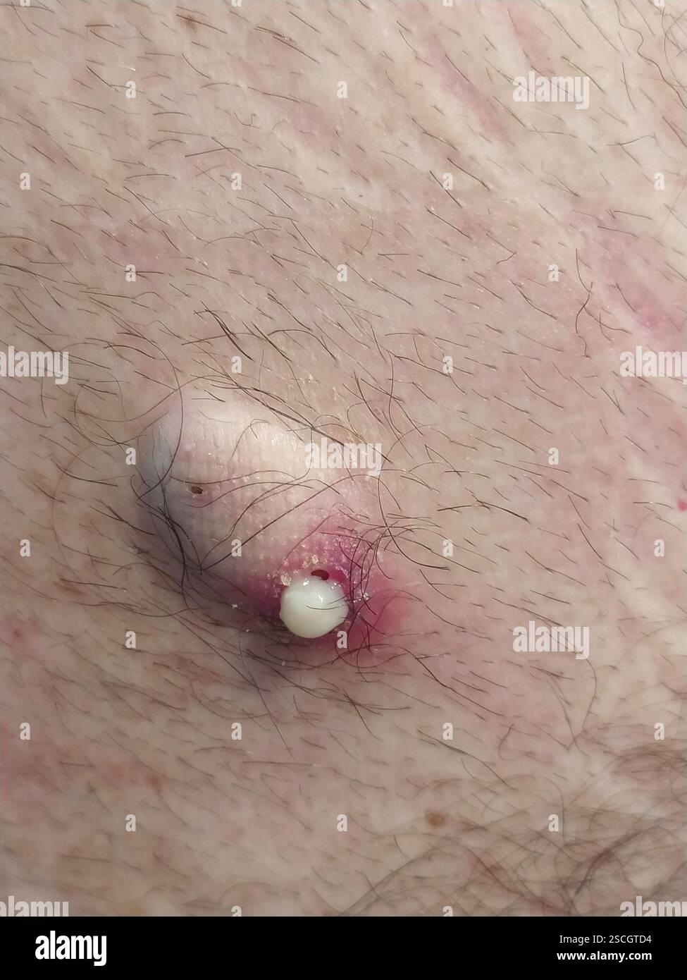 Nahaufnahme einer entzündeten Hautläsion mit eitrigem Ausfluss – medizinisches Konzept Stockfoto