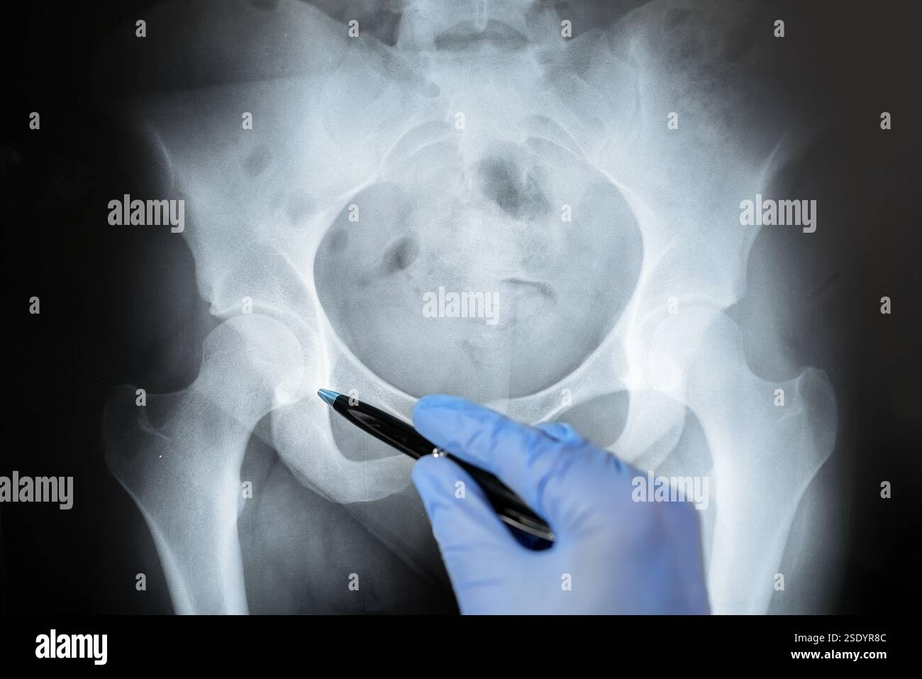 Röntgenologische Untersuchung des Beckenknochens durch Arzt. Hand eines Arztes, der die betroffene Stelle analysiert und mit einem Stift auf die betroffene Stelle zeigt. Stockfoto