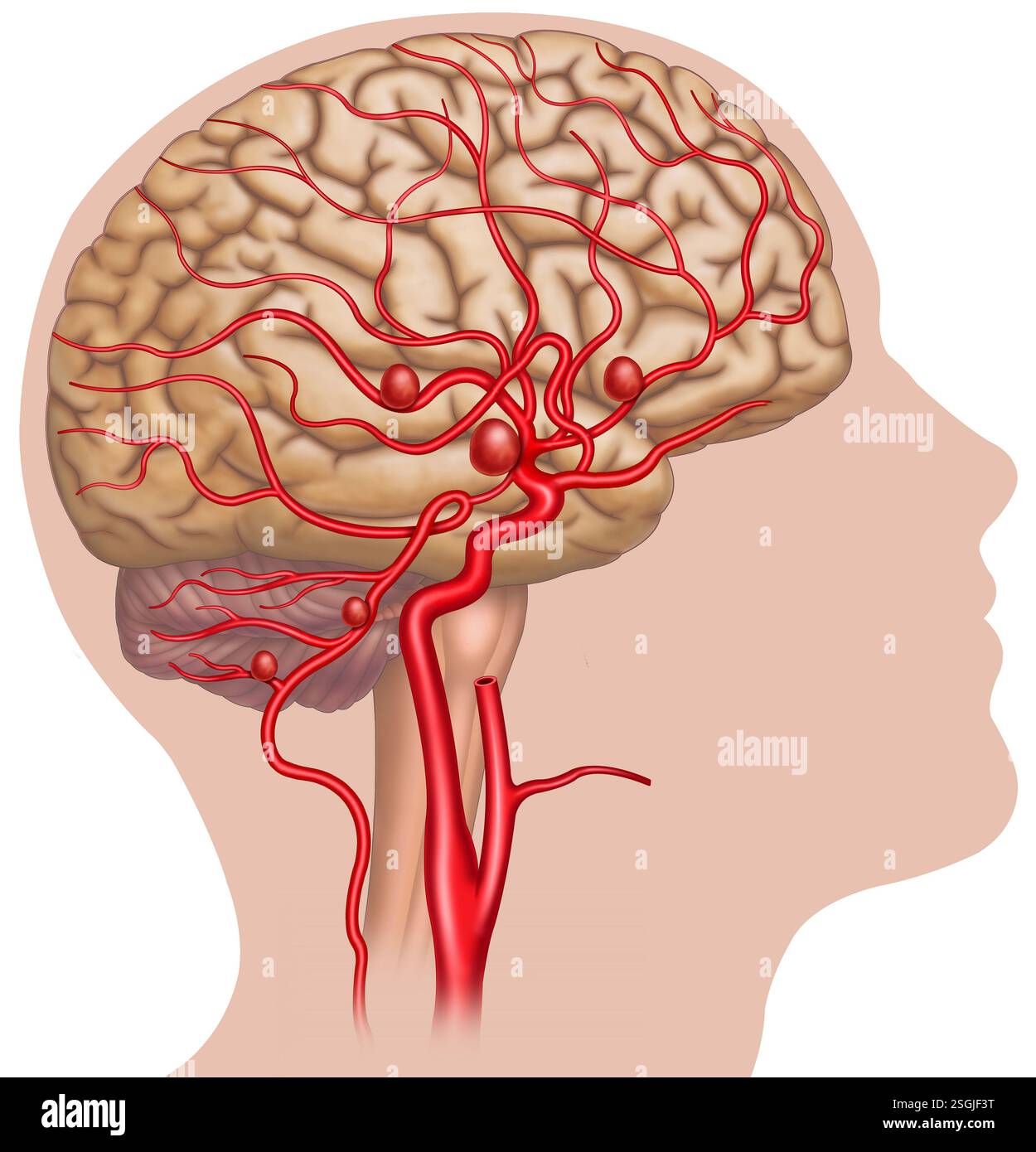 Diagramm des menschlichen Kopfes und der Hauptarterien des Gehirns. Es zeigt ein Aneurysma, eine anormale Dilatation in der Wand der Blutgefäße. Stockfoto