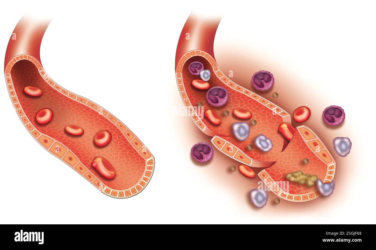 Arterielles Schema, bei dem es zu einer Ruptur (Hämostase) kommt, die Blutungen mit der Bildung des Thrombozytenstopfens und der Blutgerinnung stoppt. Stockfoto