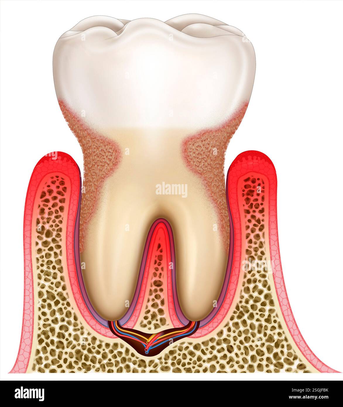 Illustration eines Zahnes mit fortgeschrittener Gingivitis. Stockfoto
