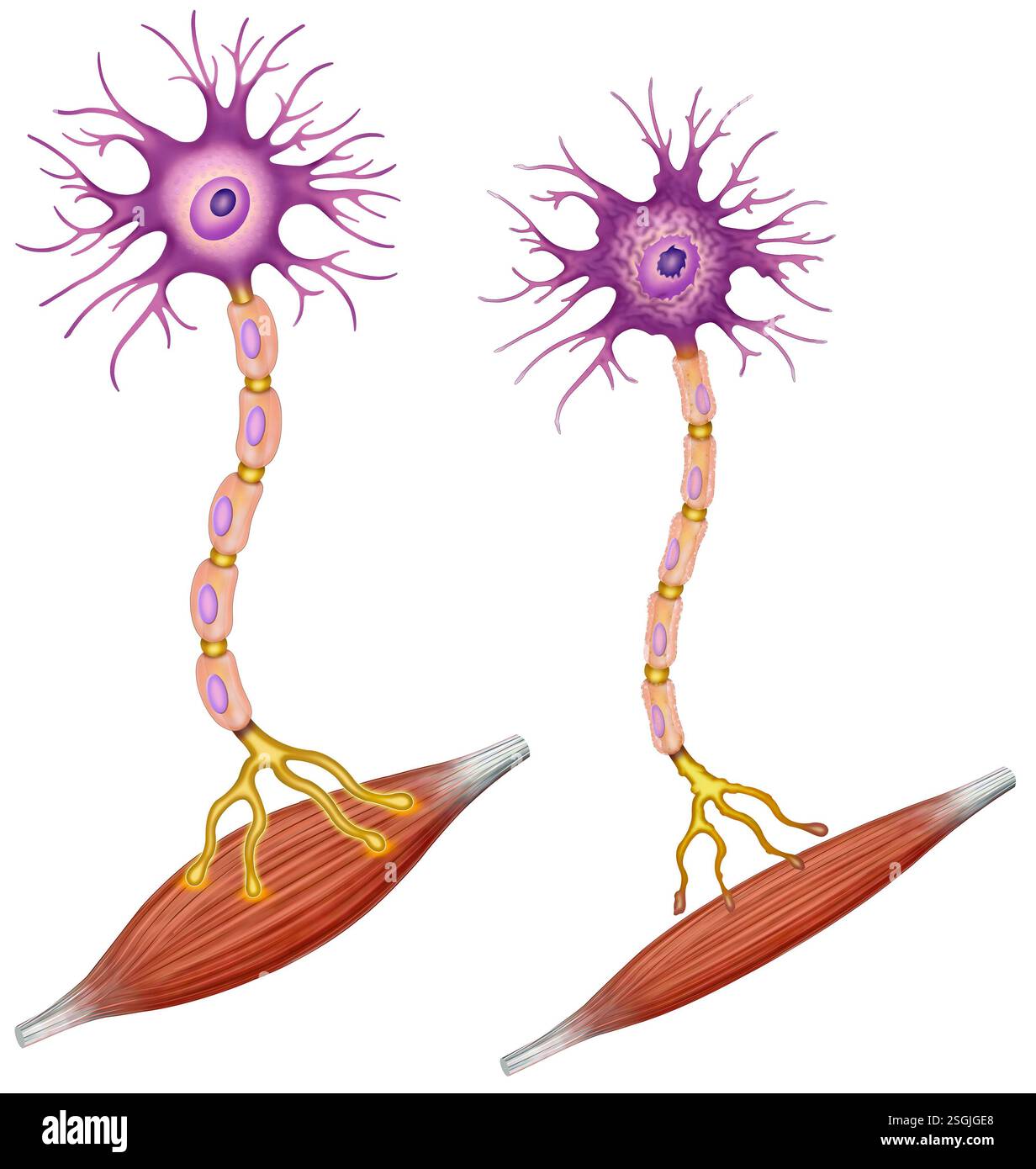 Darstellung der amyotrophen Lateralsklerose, einer progressiven neurodegenerativen Erkrankung, die Muskelschwäche und Lähmung verursacht. Stockfoto