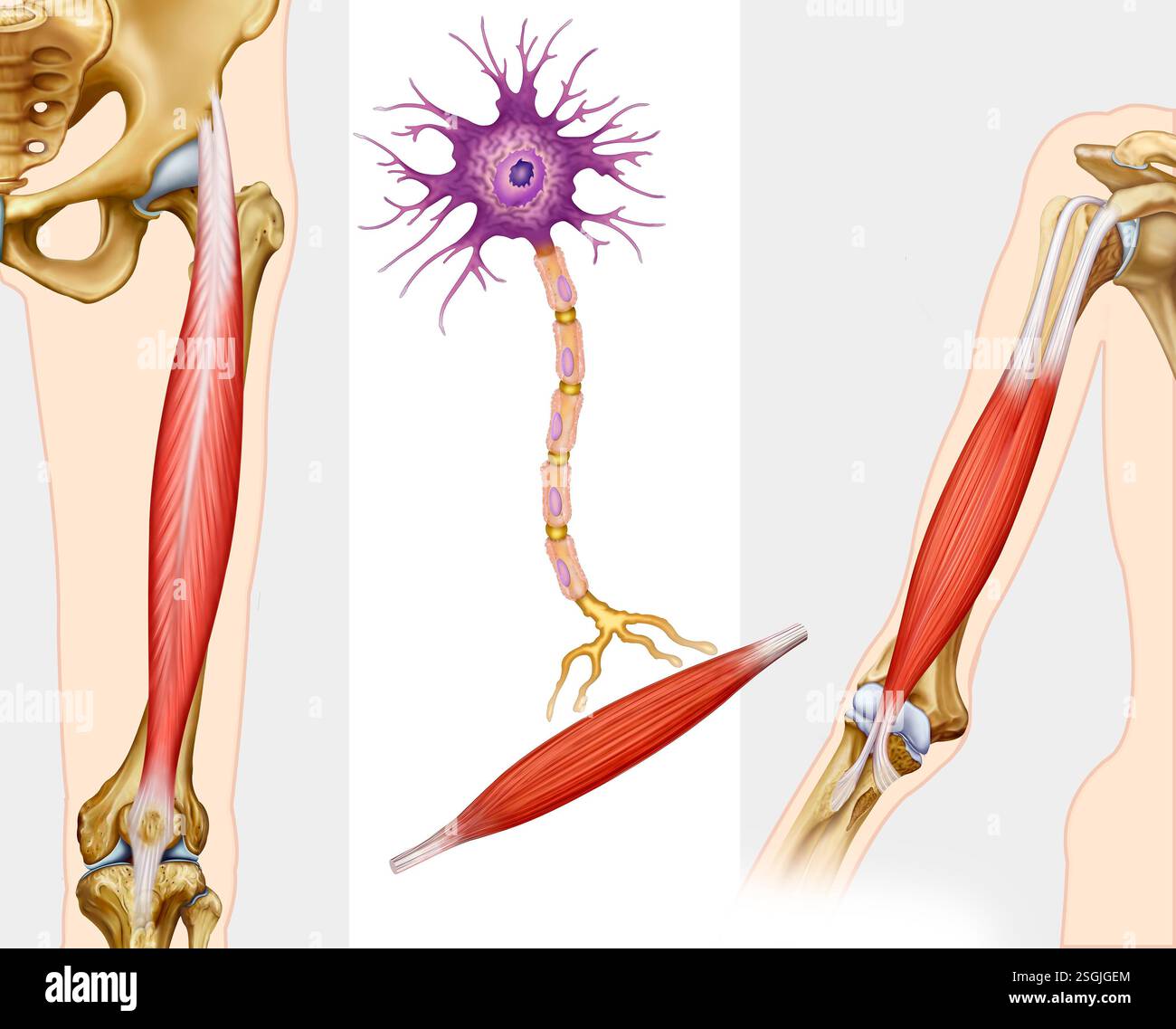Illustration der amyotrophen Lateralsklerose, einer progressiven neurodegenerativen Erkrankung, die Muskelschwäche und Lähmung verursacht. Stockfoto