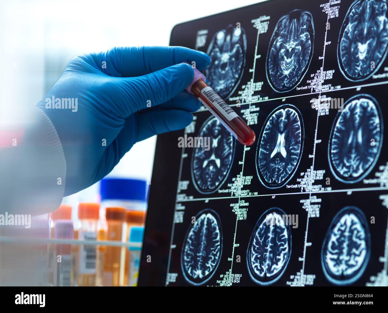 Neurologie Forschung, Patienten Blutprobe wird mit dem medizinischen Scan während einer klinischen Studie überprüft Stockfoto