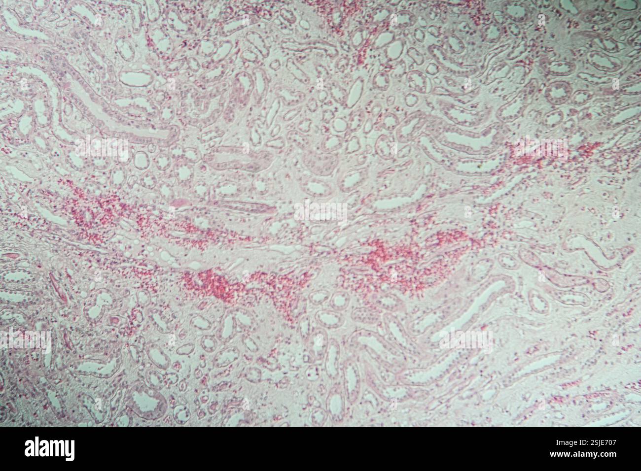 Poly Nephritis, Gewebe unter dem Mikroskop 100x Stockfoto