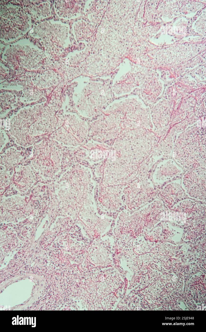 Entzündetes Gewebe unter dem Mikroskop 100x Stockfoto