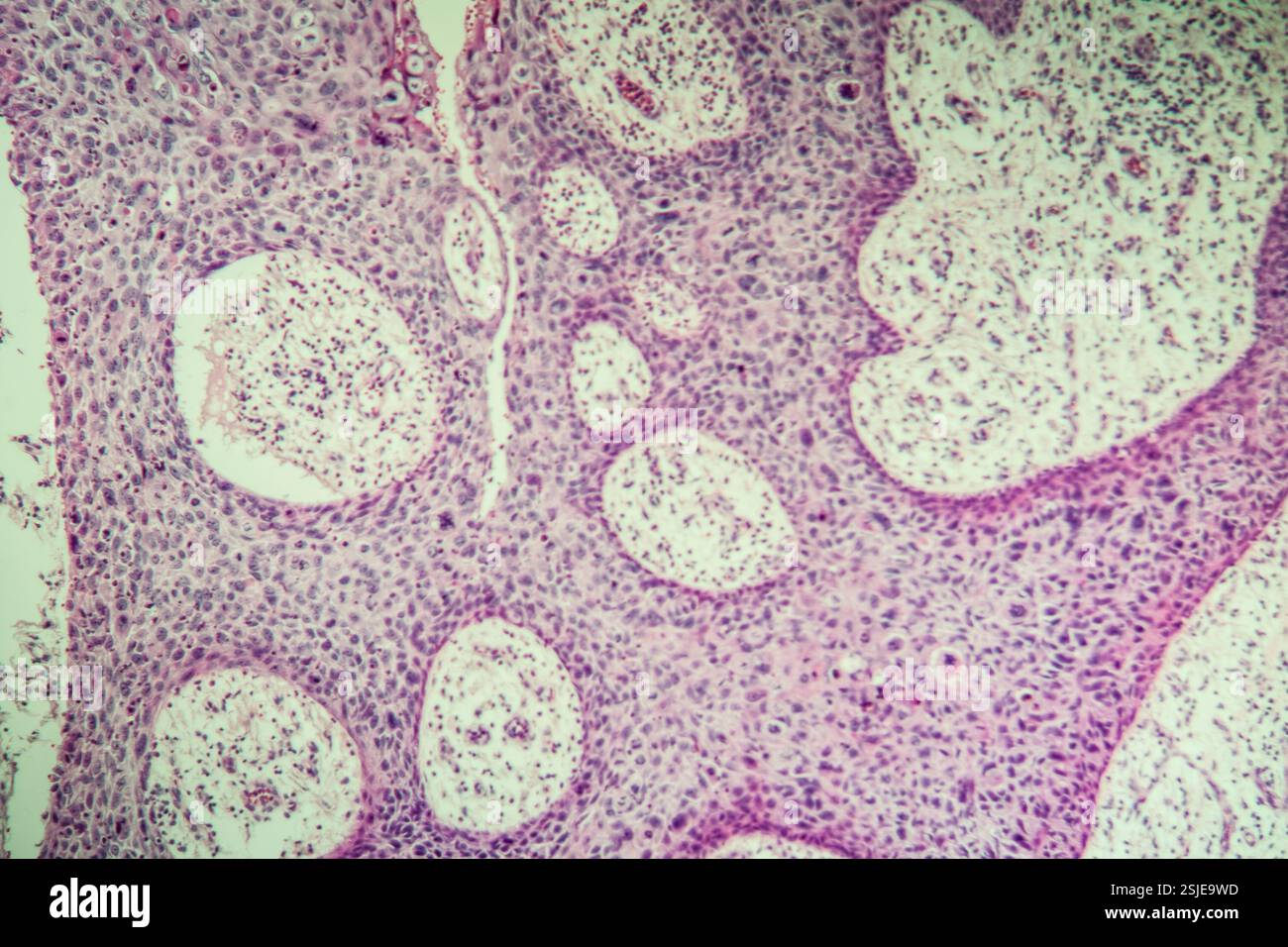 Tumorerkranktes Gewebe unter dem Mikroskop 100x Stockfoto