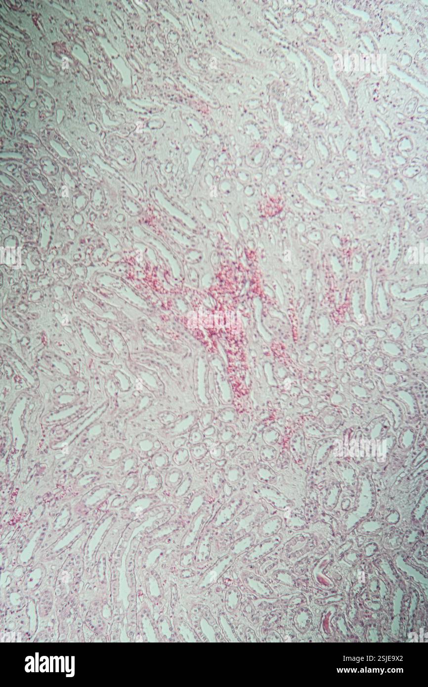 Poly Nephritis, Gewebe unter dem Mikroskop 100x Stockfoto