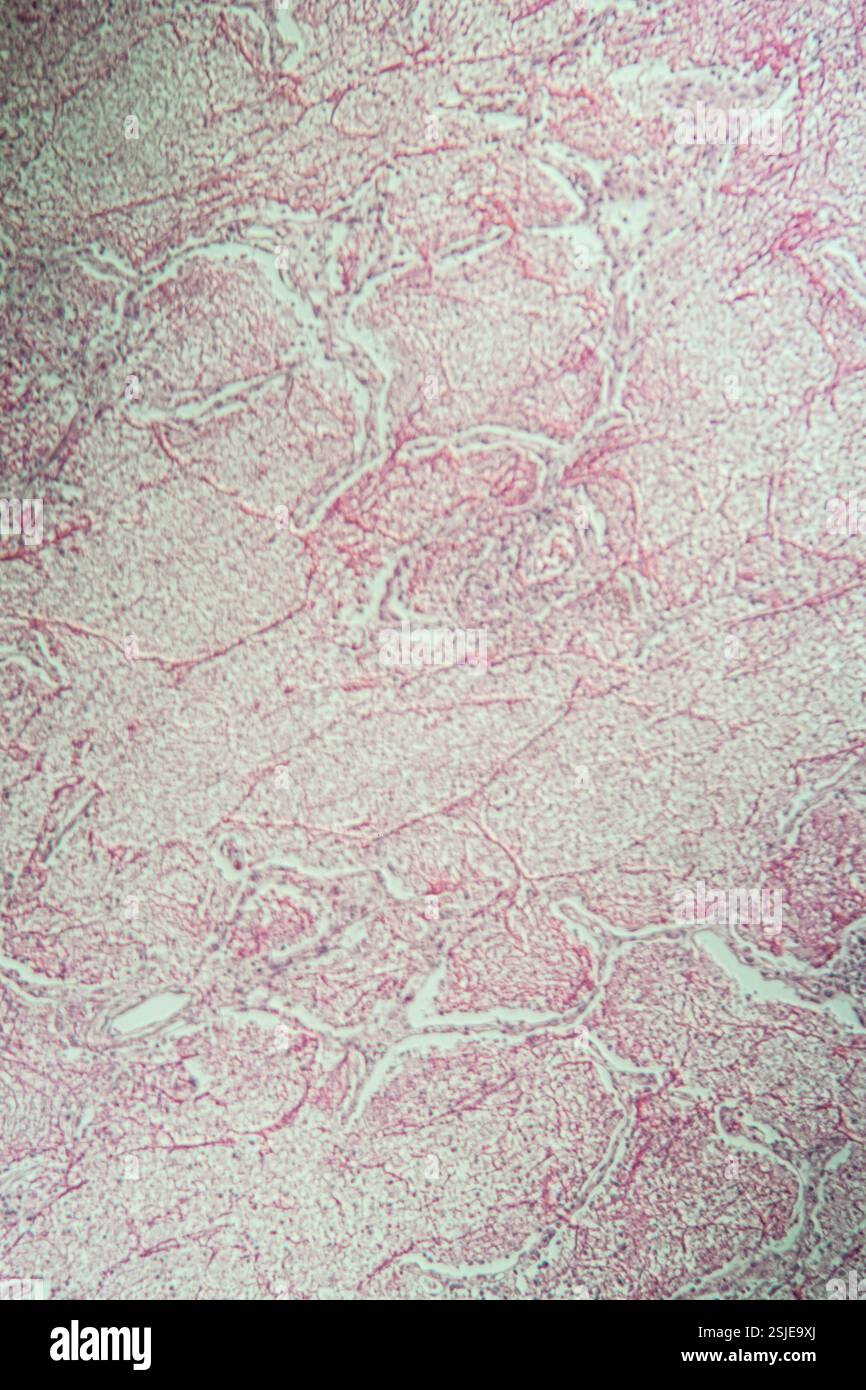 Entzündetes Gewebe unter dem Mikroskop 100x Stockfoto