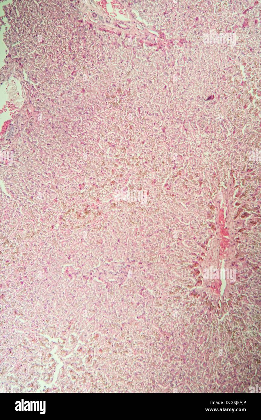 Leberkrankheitsgewebe unter dem Mikroskop 100x Stockfoto