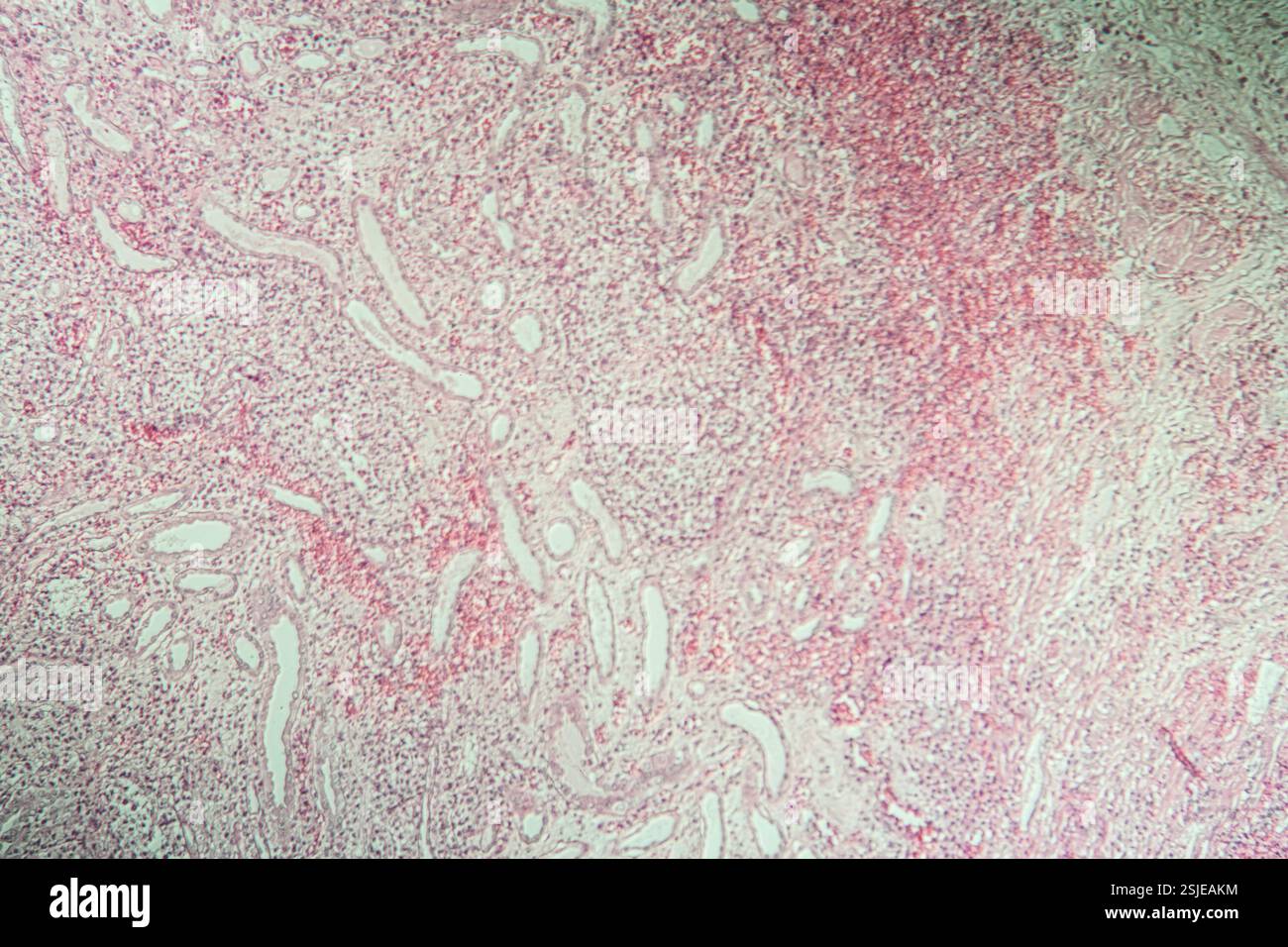 Poly Nephritis, Gewebe unter dem Mikroskop 100x Stockfoto
