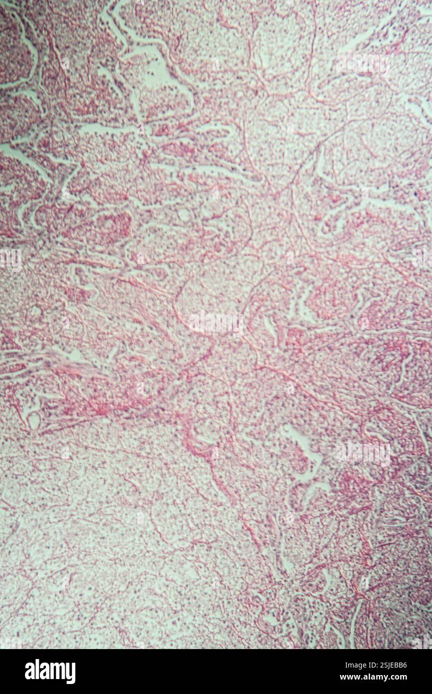 Entzündetes Gewebe unter dem Mikroskop 100x Stockfoto