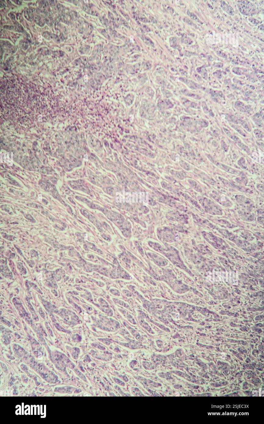 Krebsgewebe unter dem Mikroskop 100x Stockfoto