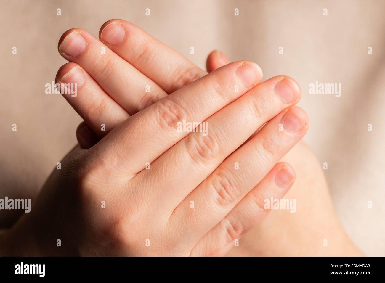 Frau zeigt ihre Hände mit gebissenen Nägeln. Kleine Nagelplatte. Schlechte Maniküre Stockfoto